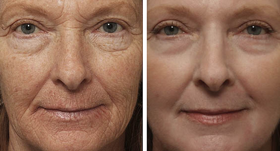 croton oil peel before after