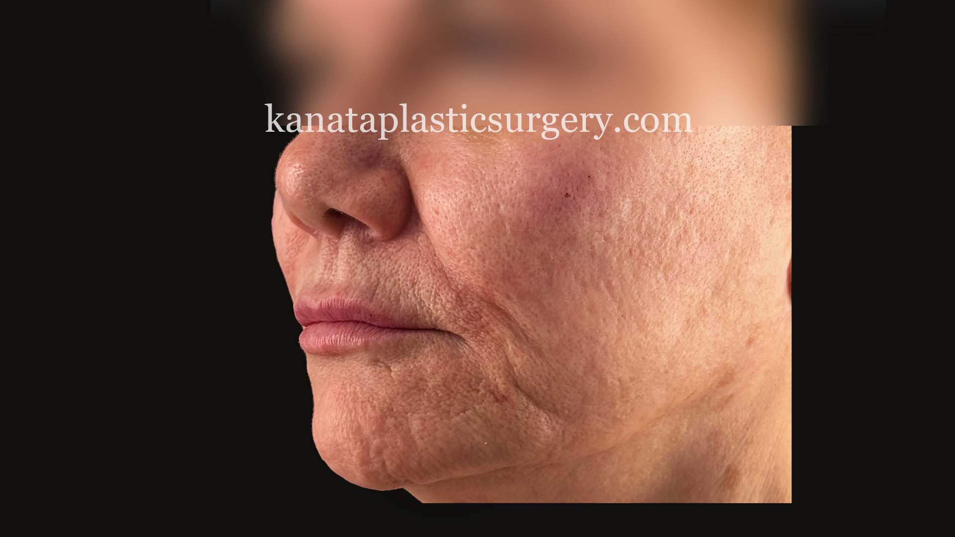 croton oil peel before and after 1