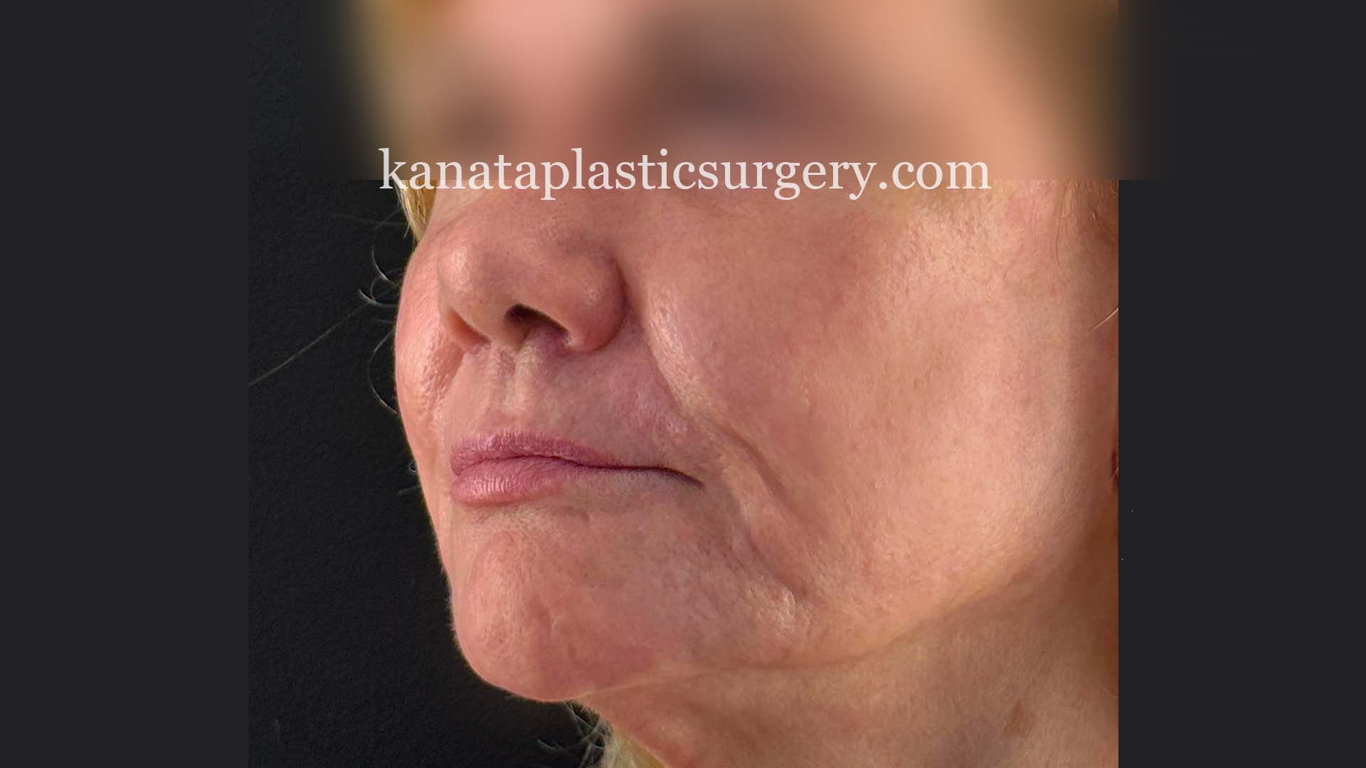 croton oil peel before and after 2