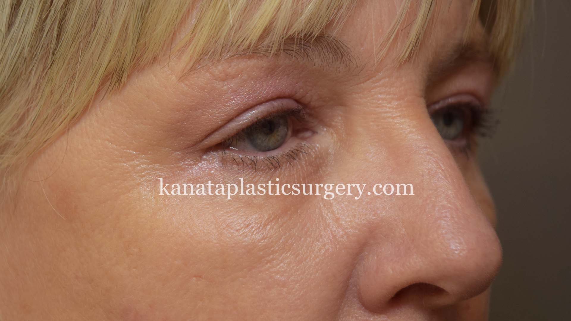 eyelid lift surgery blepharoplasty before and after2