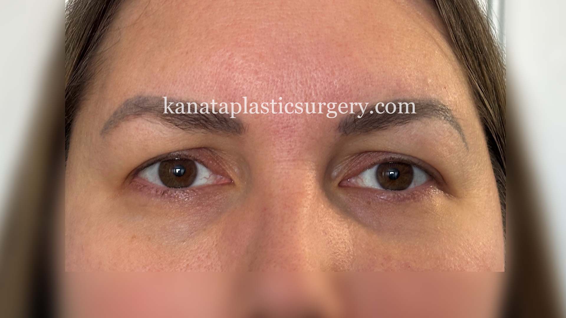 eyelid surgery before after 1