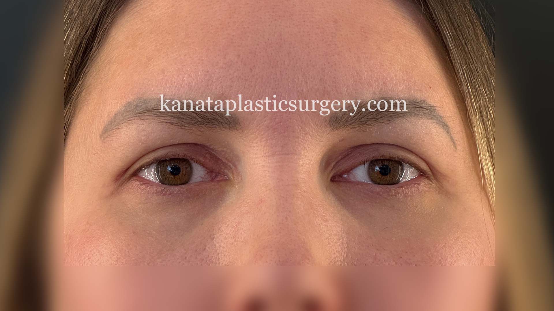 eyelid surgery before after 2