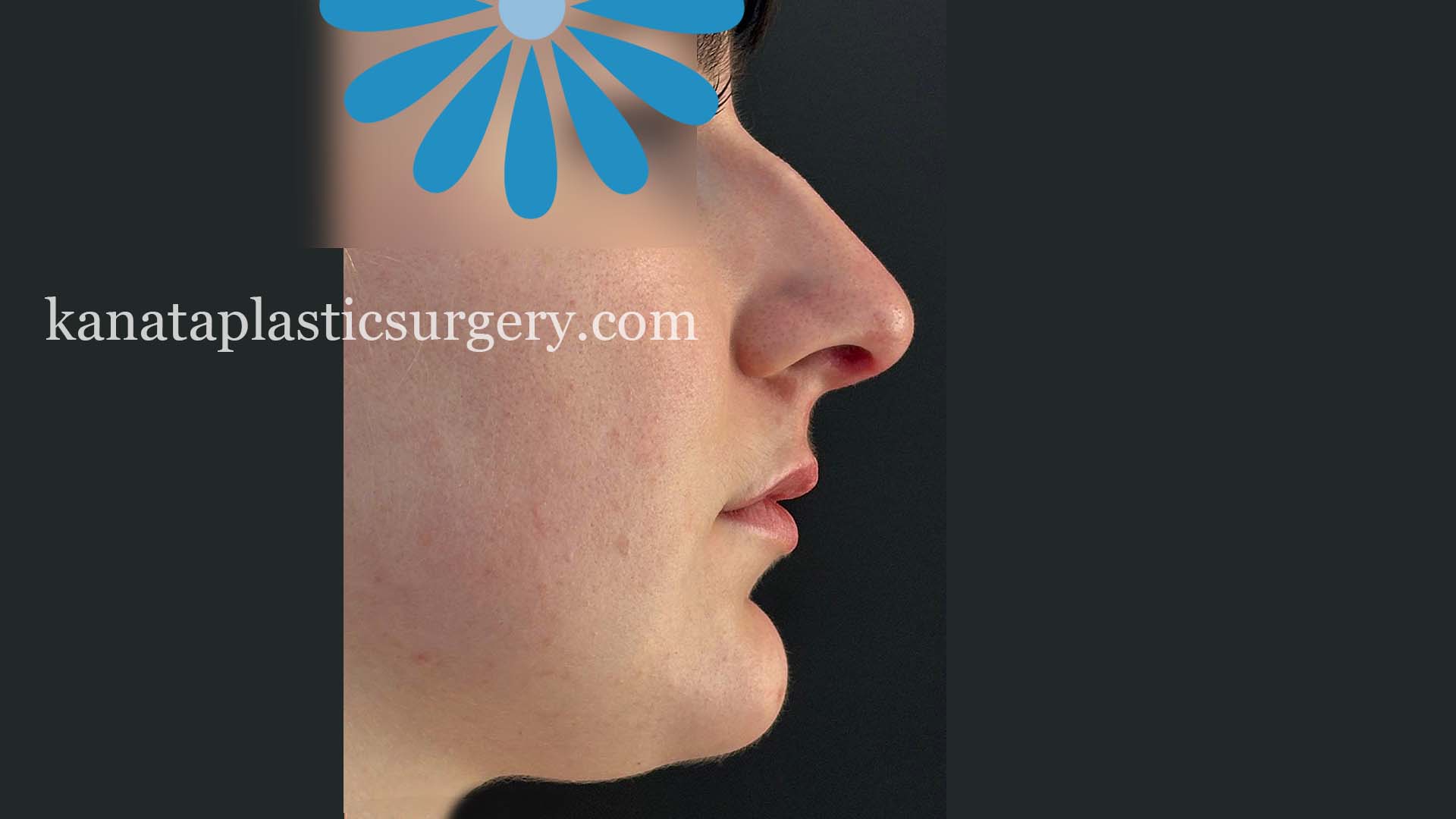 nose job ottawa before and after 1