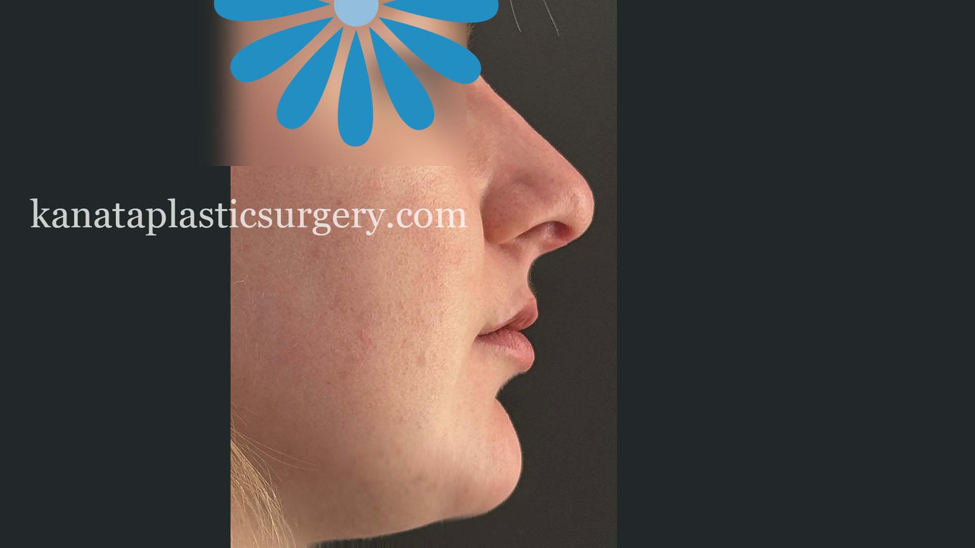 nose job ottawa before and after 2