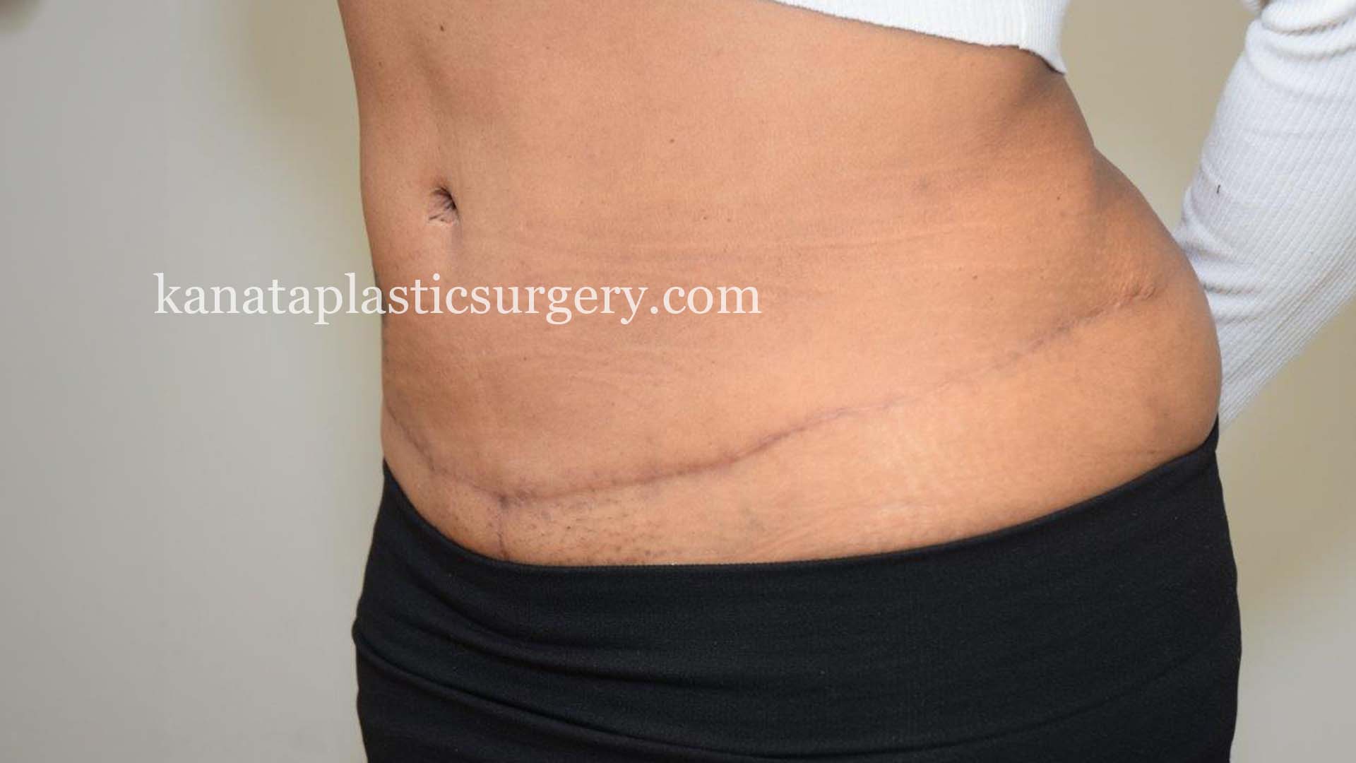 ottawa liposuction before after pic 2