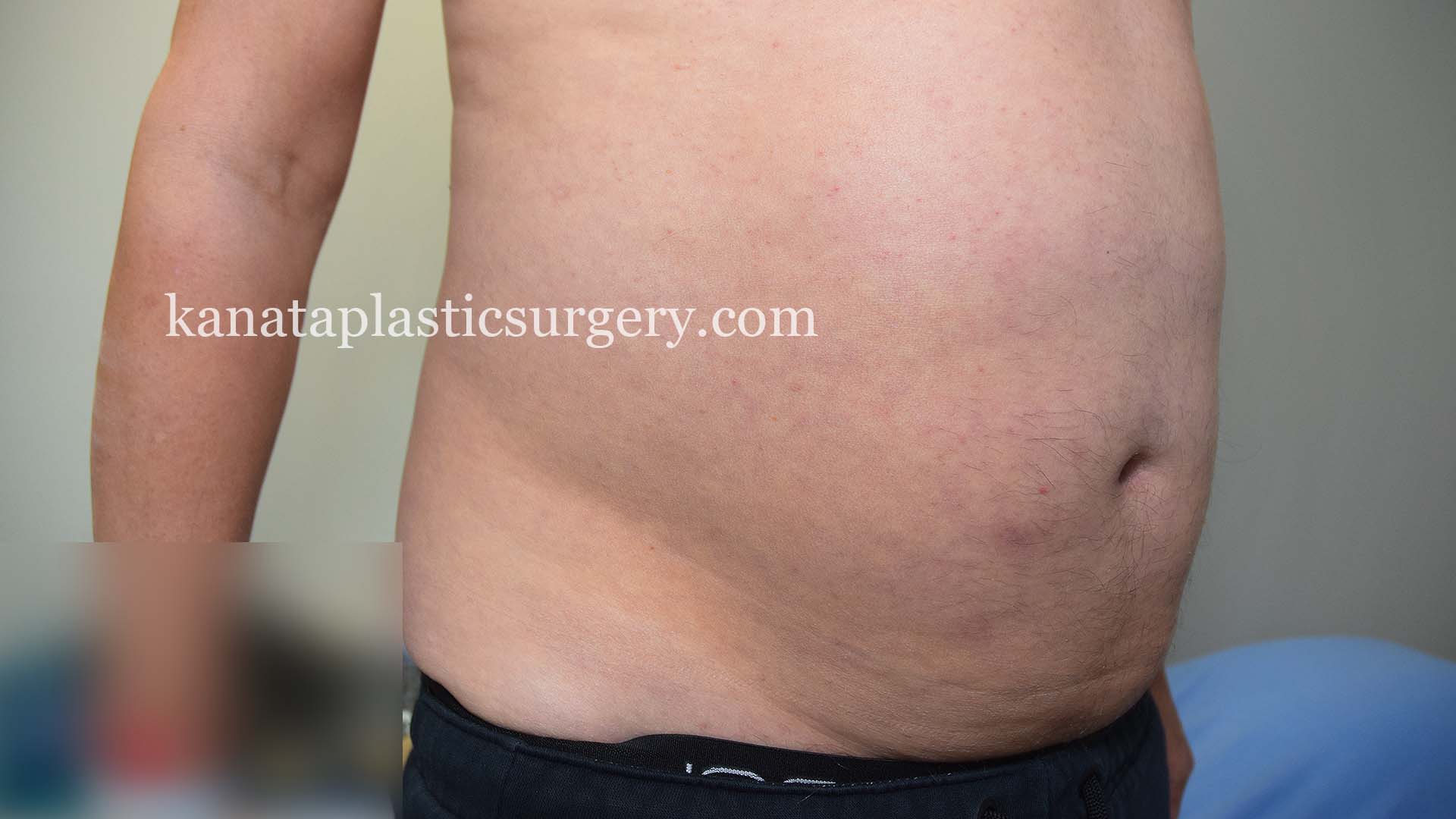 ottawa liposuction before pic 1