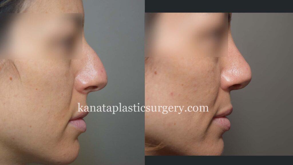 rhinoplasty nose job ottawa before and after kanata