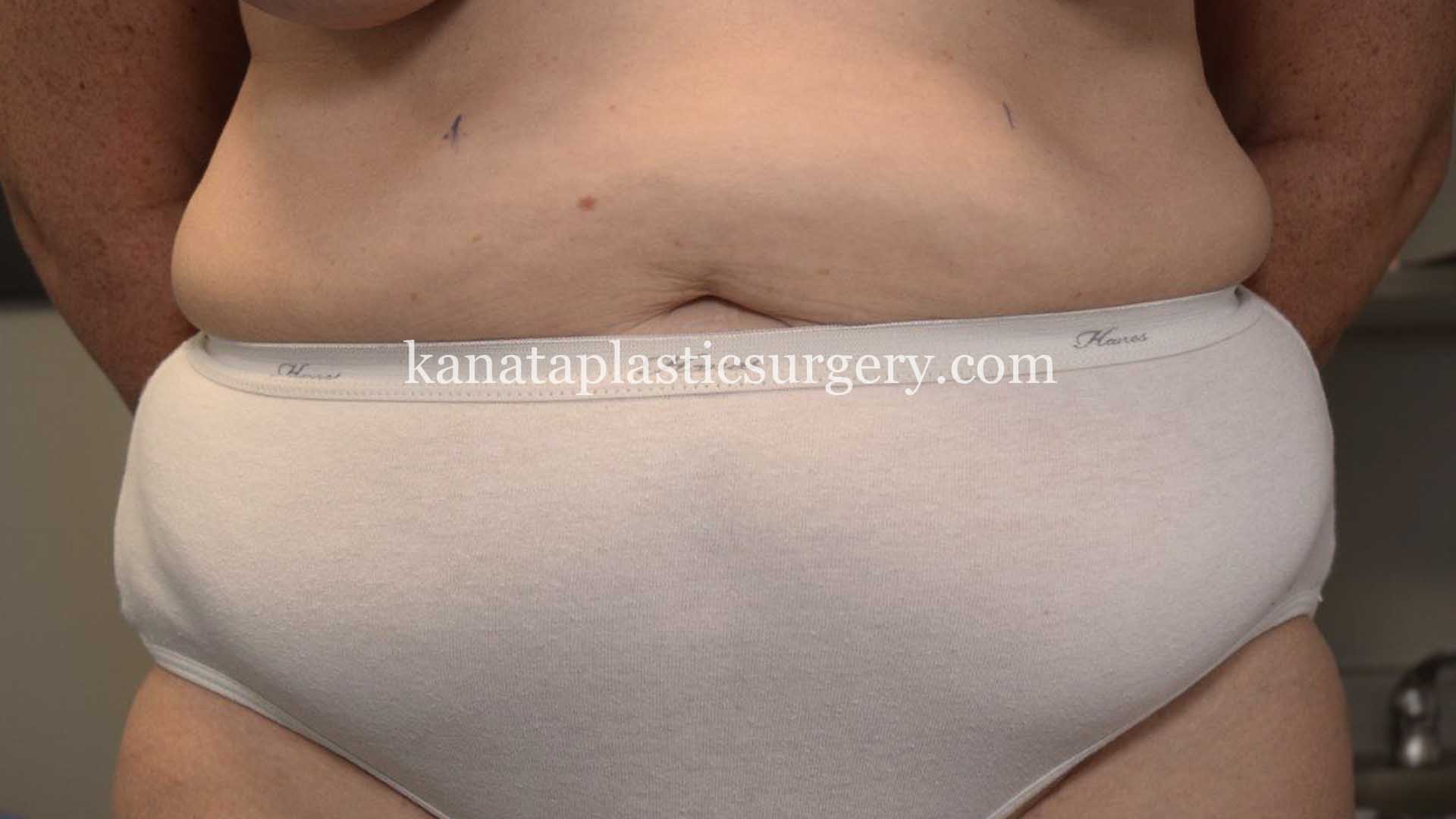 Abdominoplasty tummy tuck surgery 1