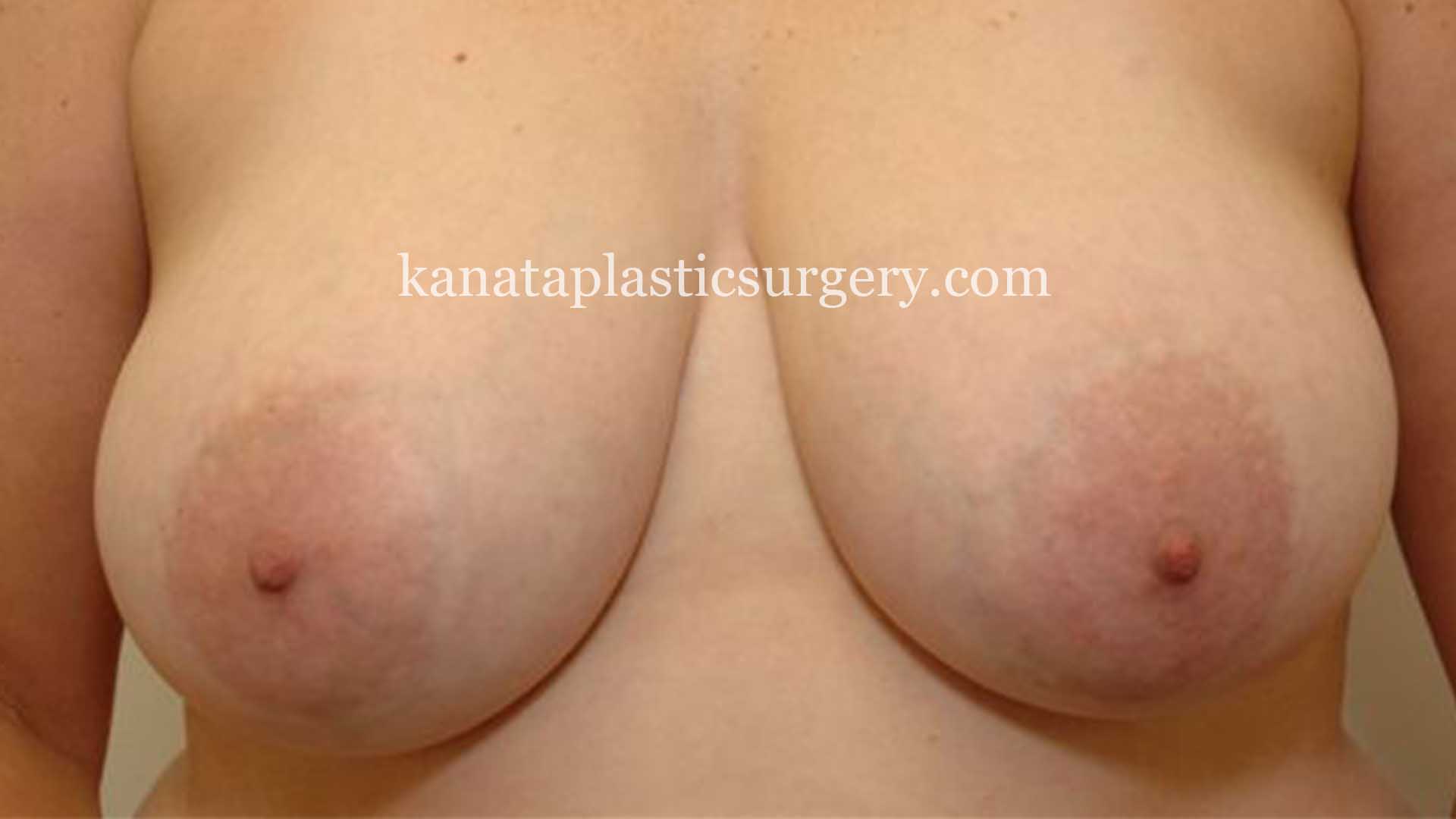 Areola Reduction on breast surgery 1