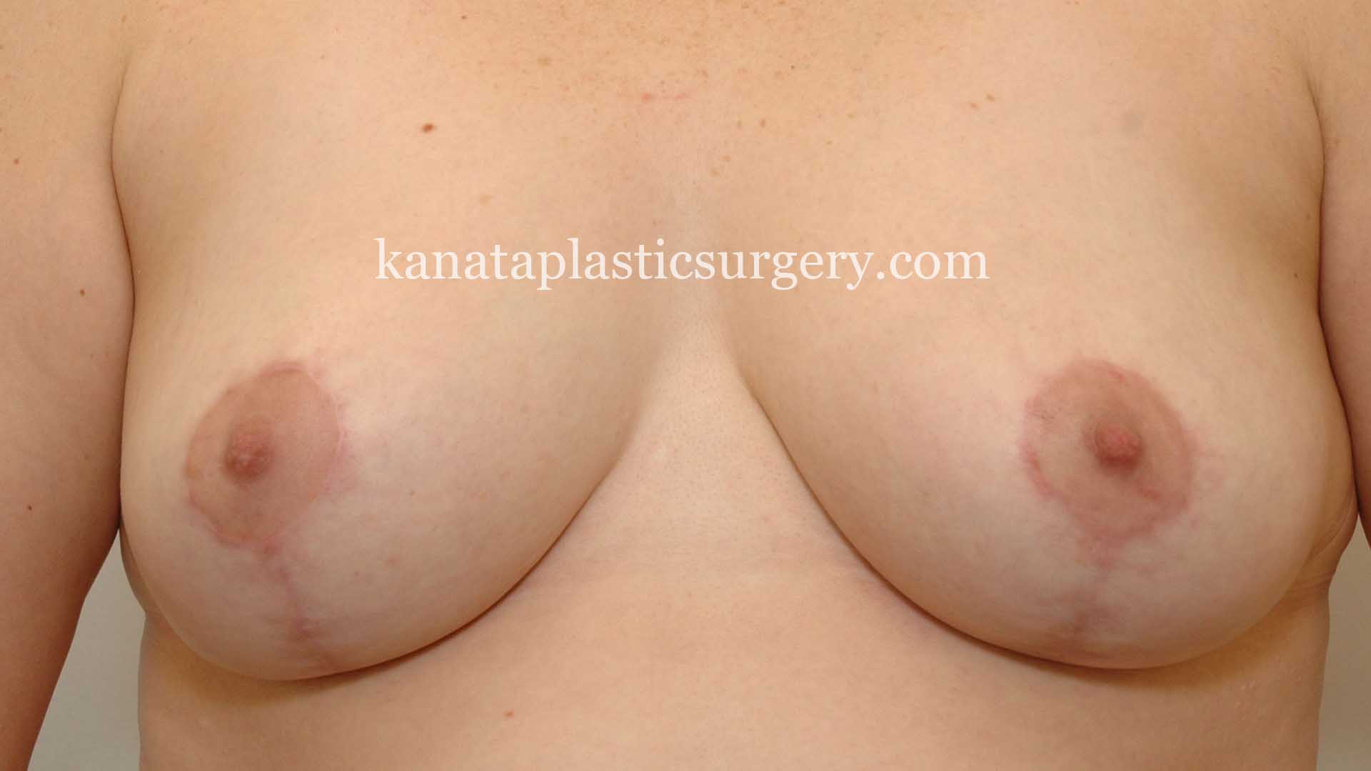 Areola Reduction on breast surgery 2