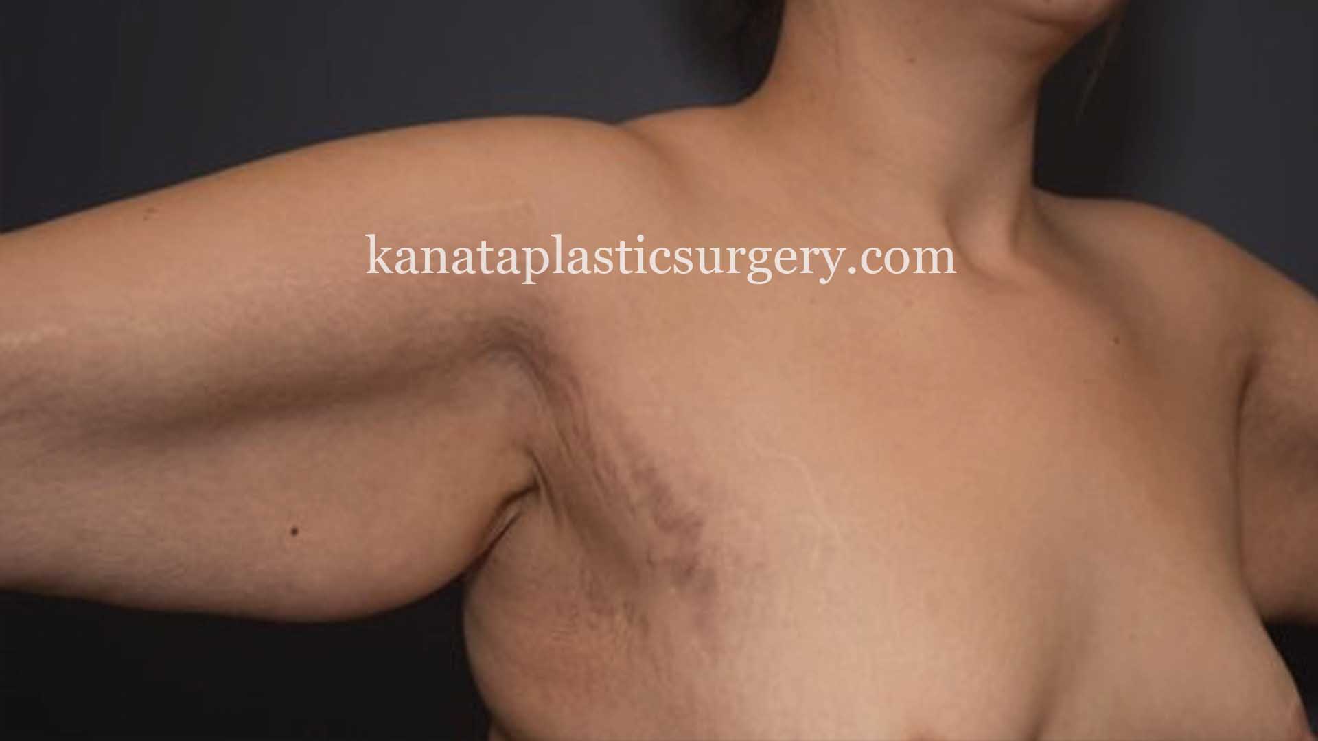 Arm lift brachioplasty bsurgery 1