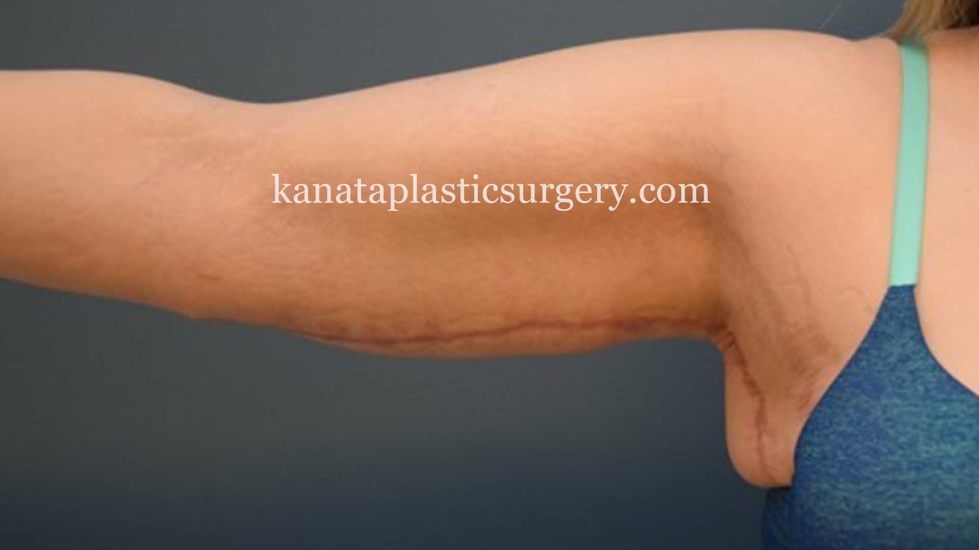 Arm lift brachioplasty surgery 2