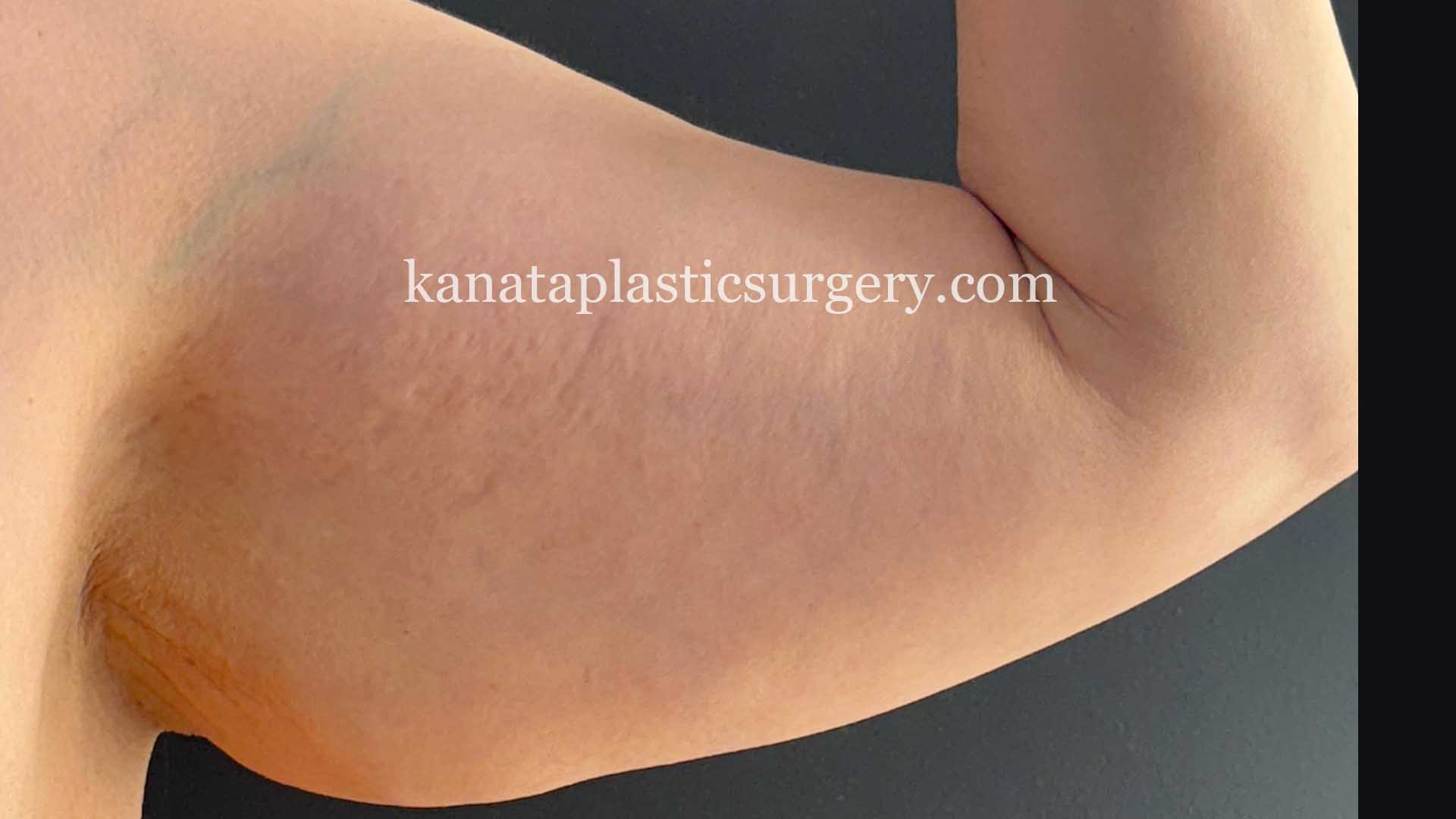 Arm lift brachioplasty surgery fat removal 1