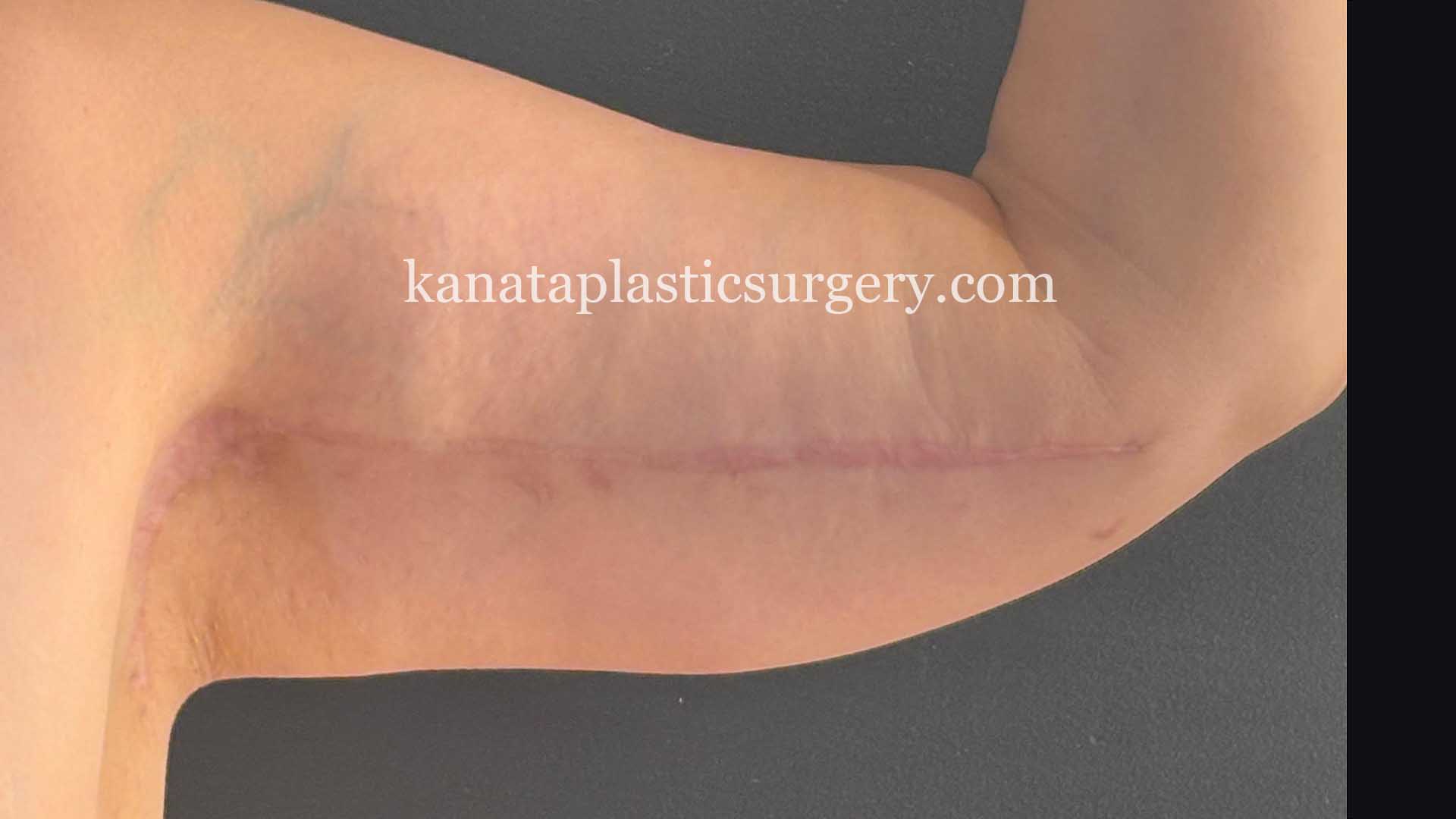 Arm lift brachioplasty surgery fat removal 2
