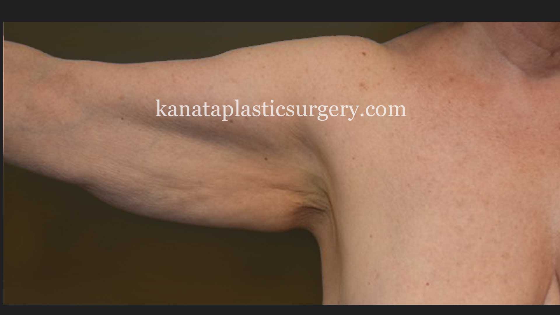 Arm lift brachioplasty woman 1