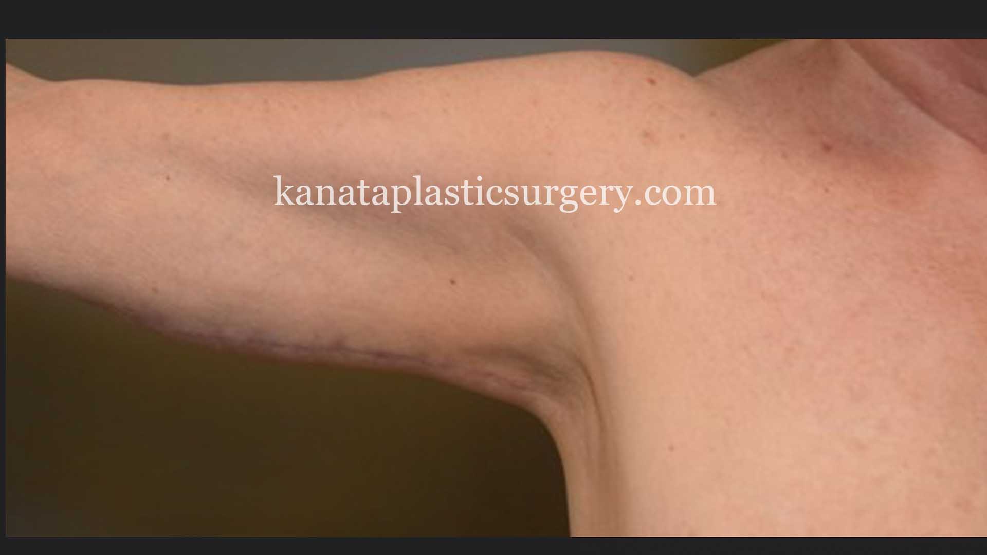 Arm lift brachioplasty woman 2