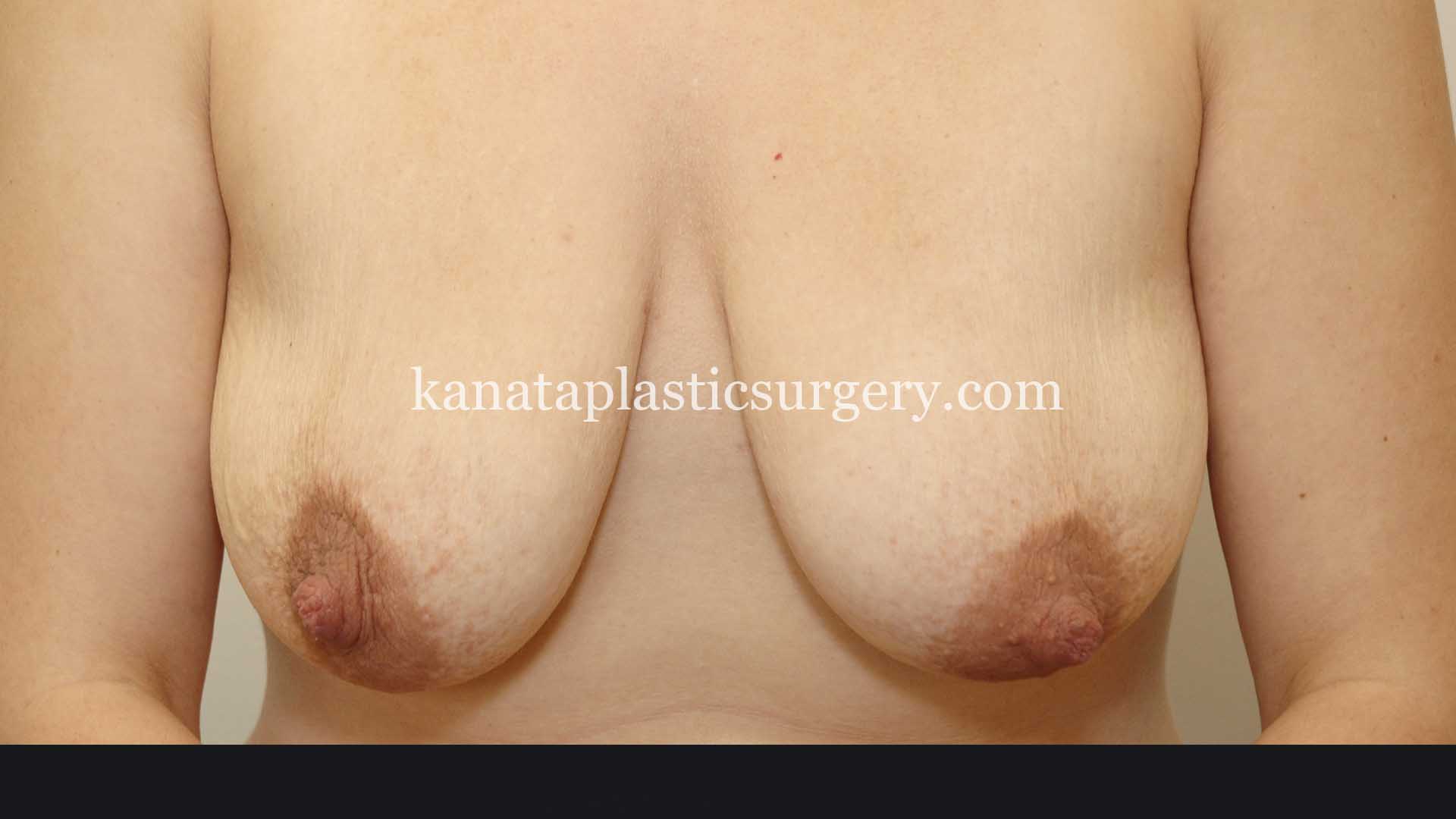 Breast Lift surgery ottawa before after 1