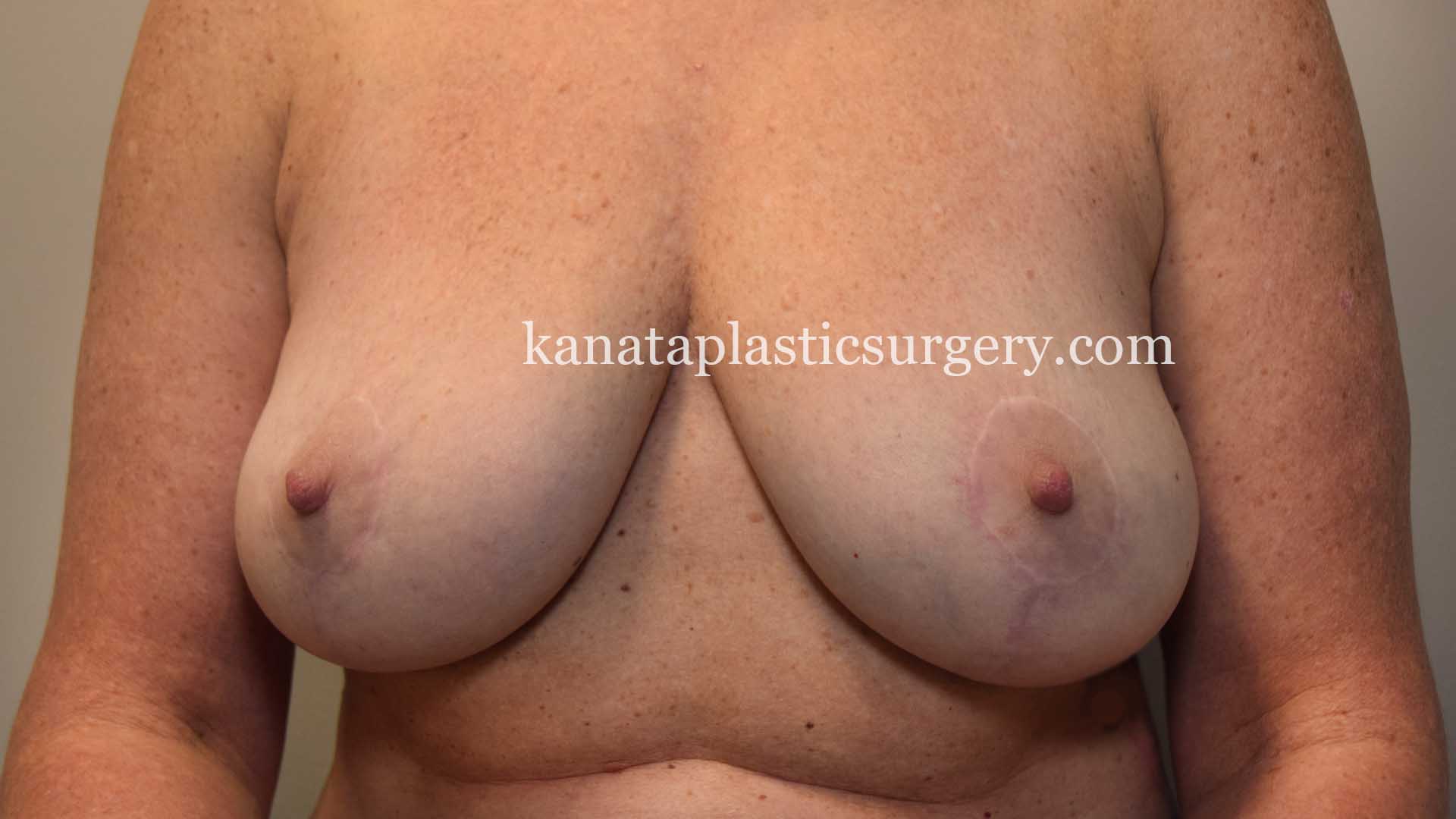 Breast lift before 2