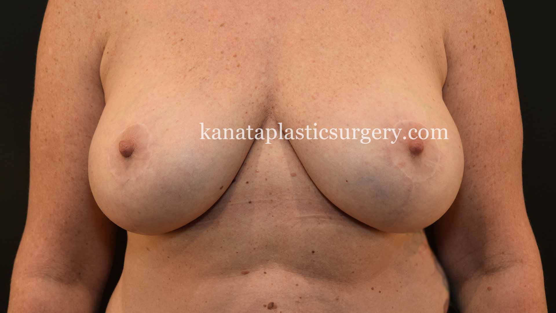 Breast reduction after 2