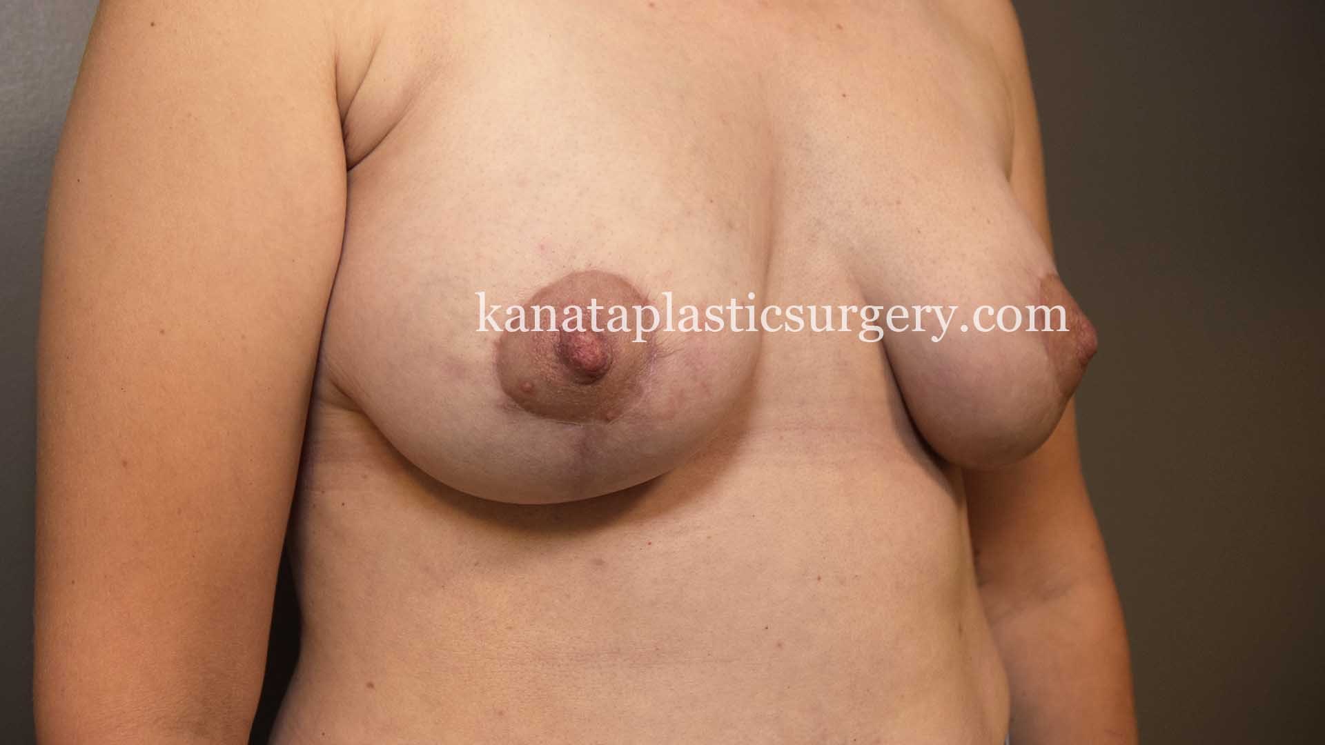 Breast reduction before after ottawa 2