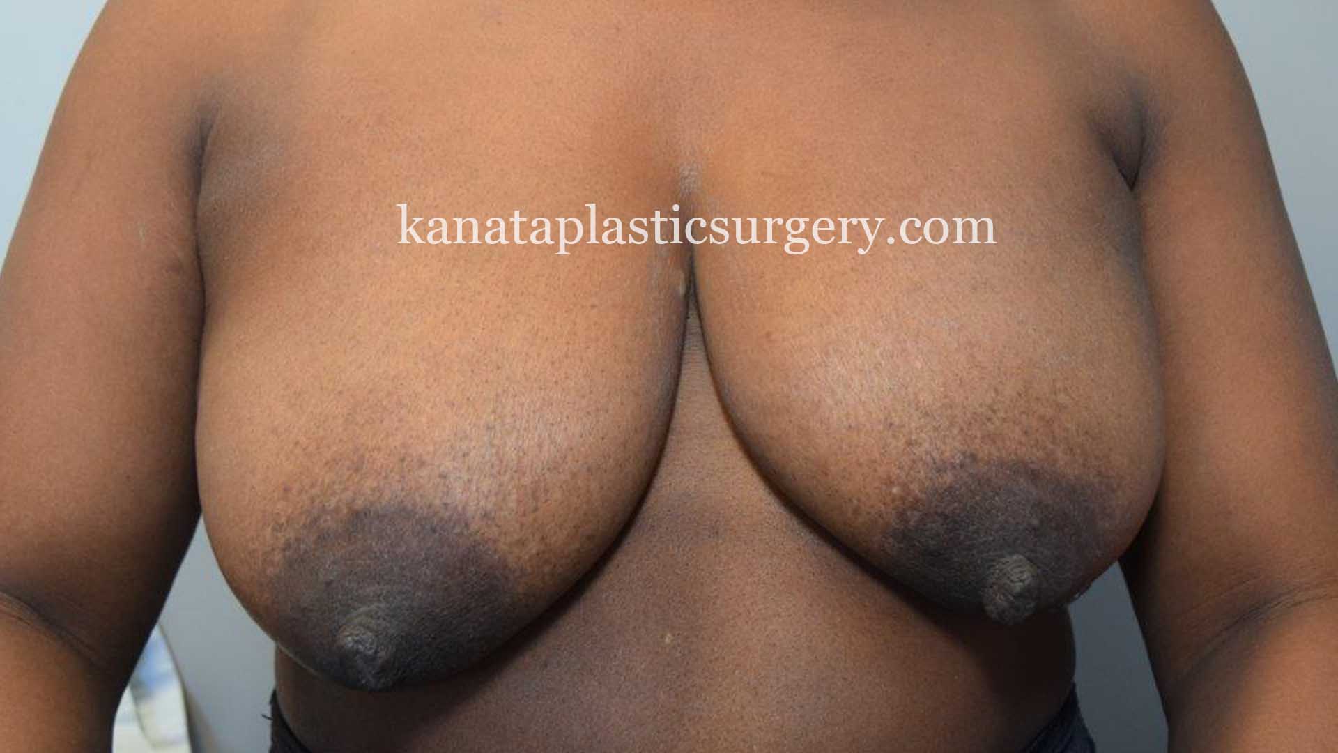 breast augmentation reduction 1