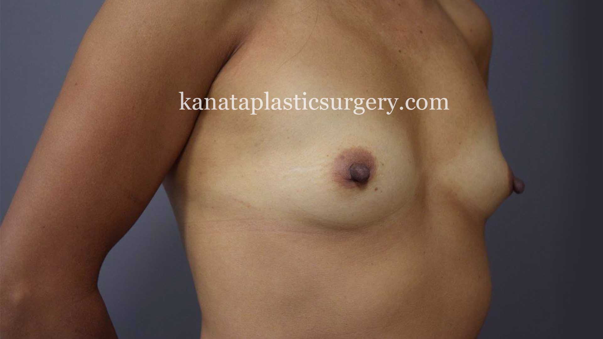 breast augmentation with implants before after 1