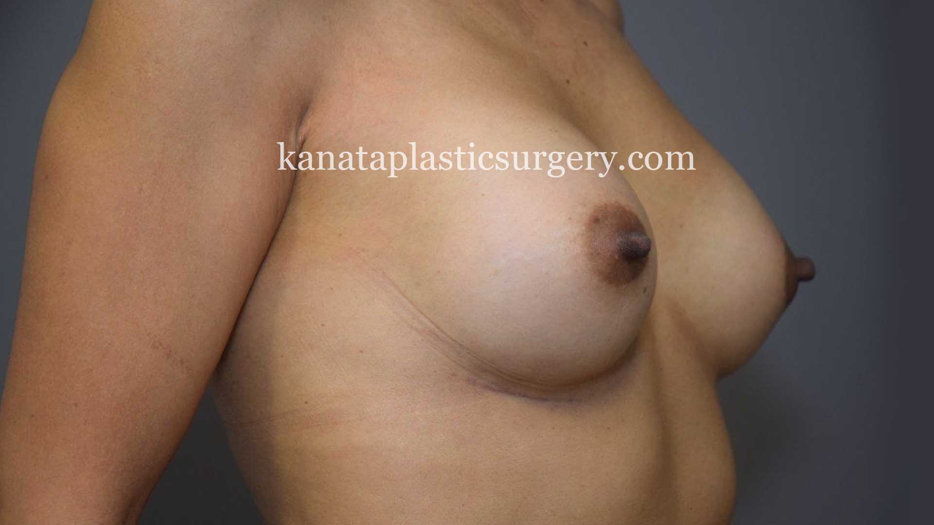 breast augmentation with implants before after 2