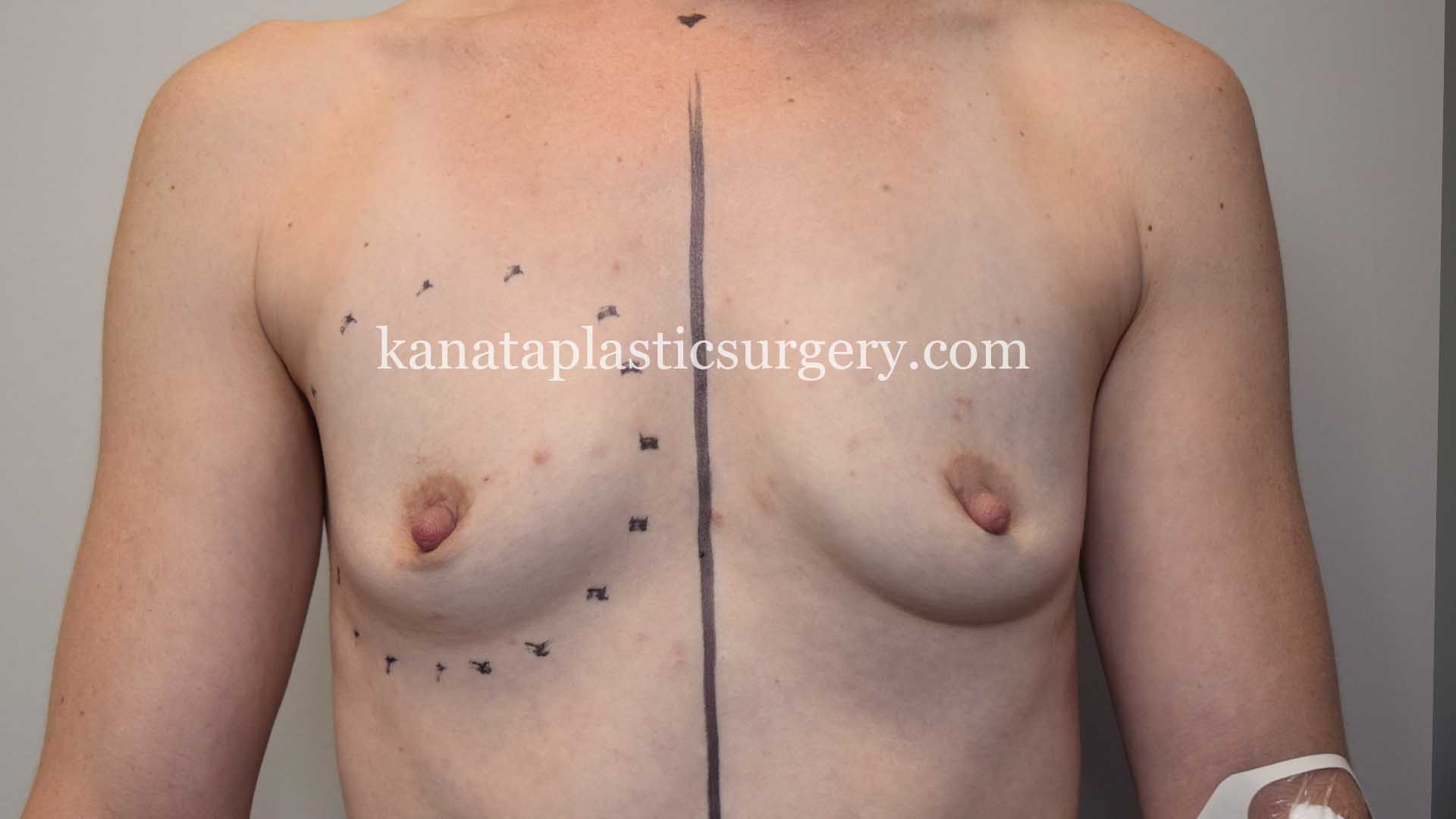 breast implants boob job Ottawa 1