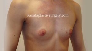 breast implants ottawa plastic surgery 1