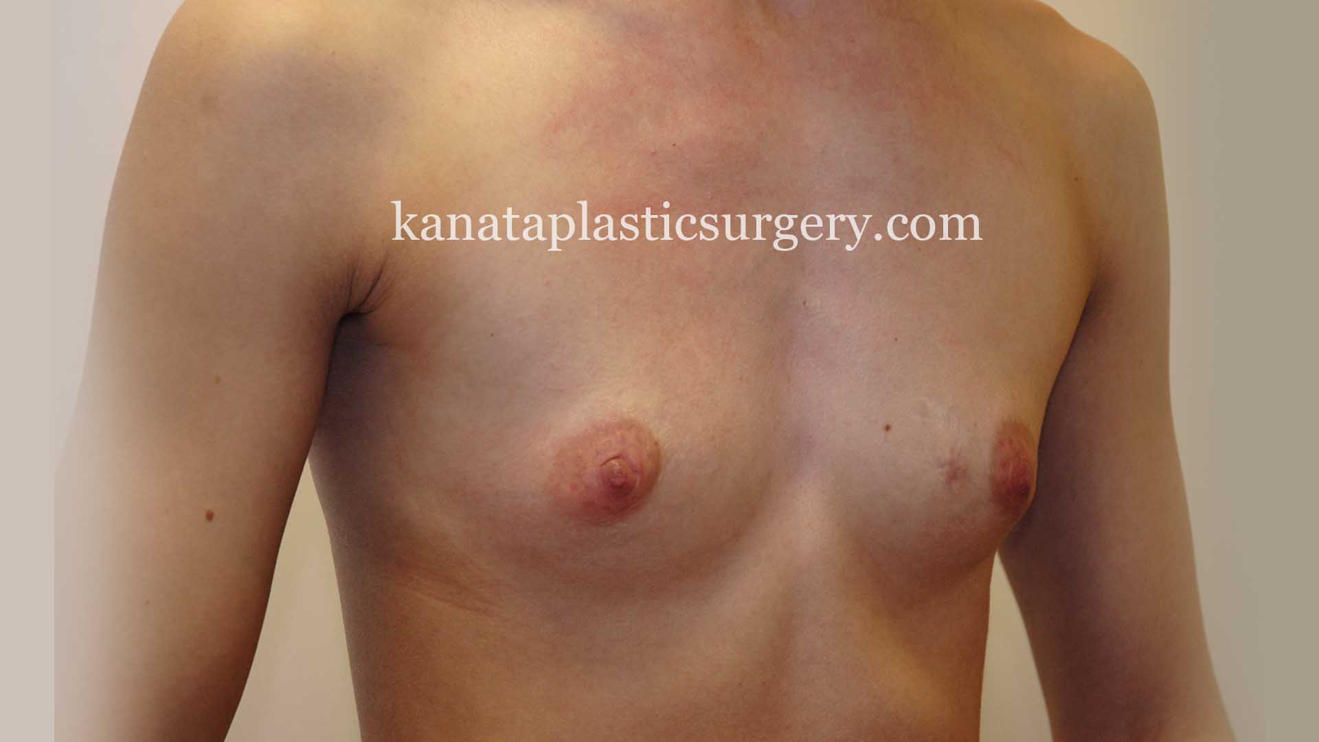 breast implants ottawa plastic surgery 1