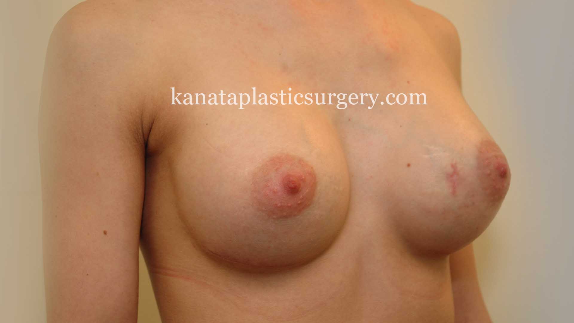 breast implants ottawa plastic surgery 2