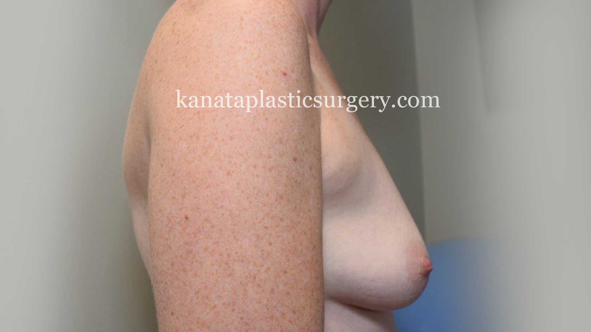 breast implnts ottawa before after 1
