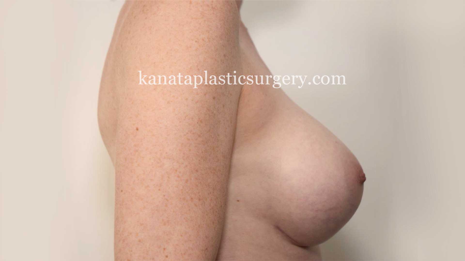 breast implnts ottawa before after 2