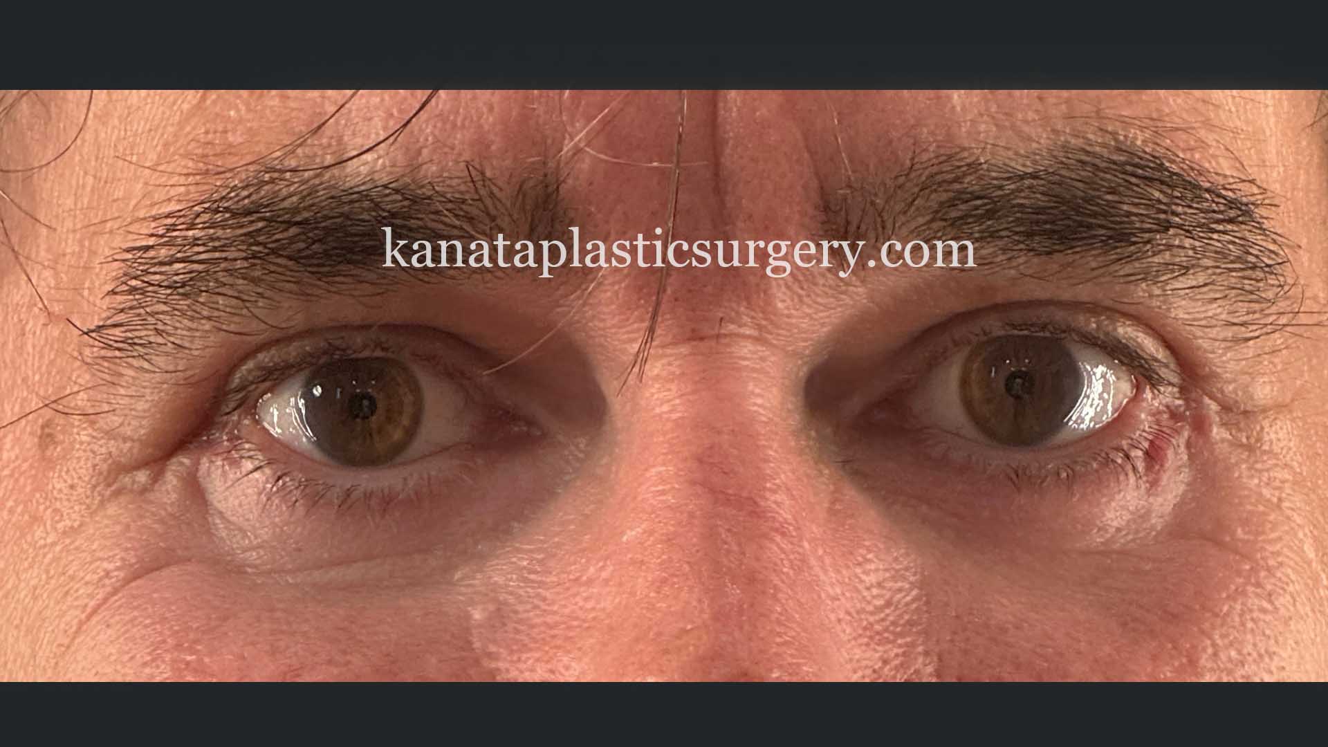 eyelid surgery blepharoplasty man after