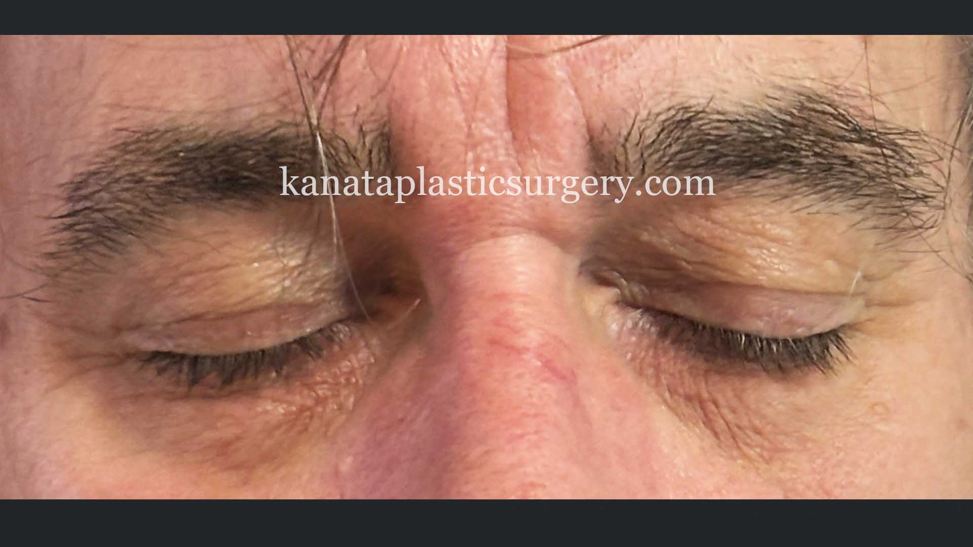 eyelid surgery blepharoplasty man before after 1