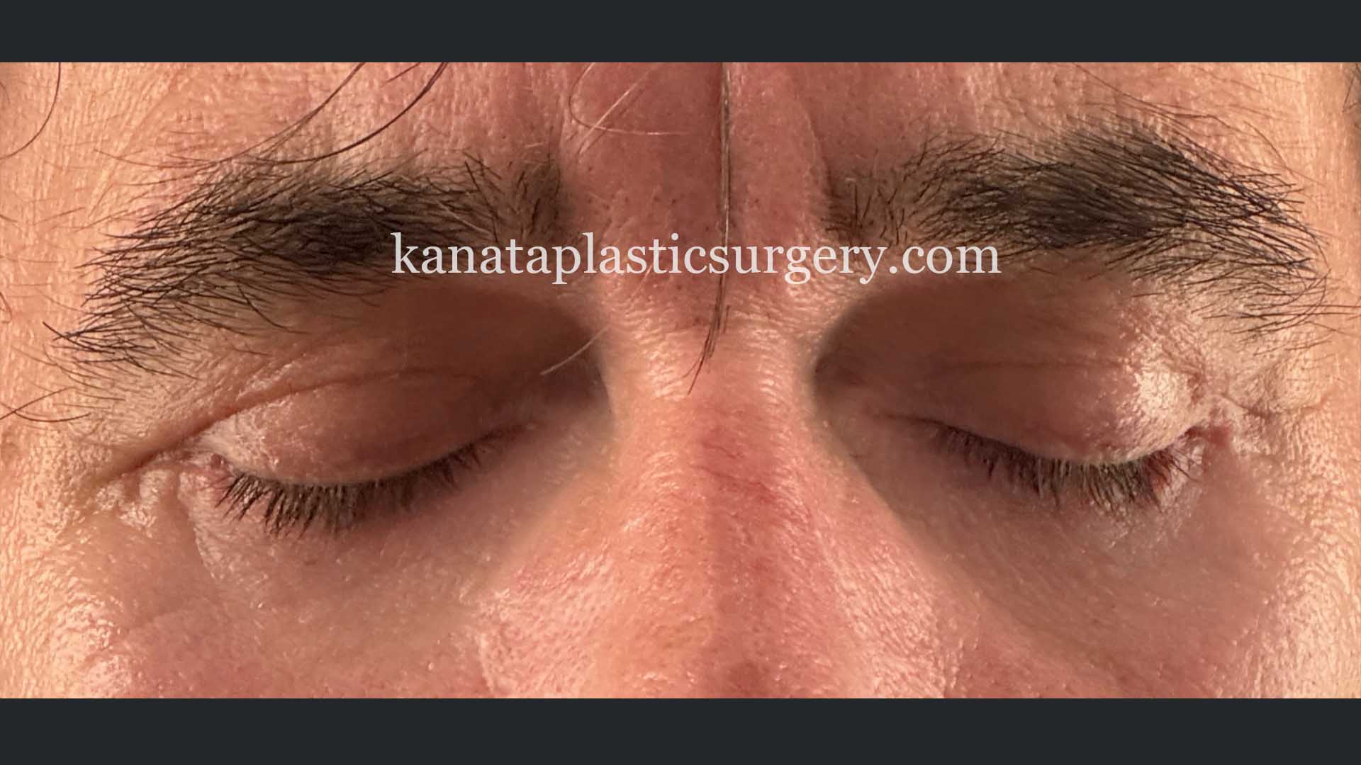 eyelid surgery blepharoplasty man before after 2
