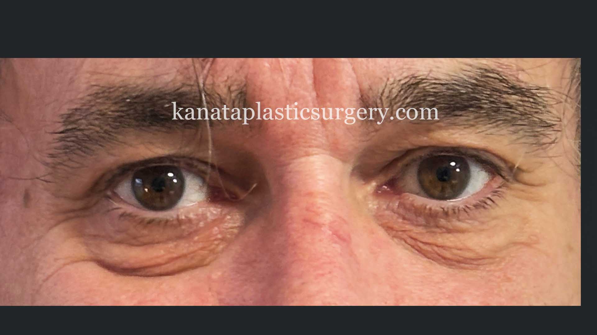 eyelid surgery blepharoplasty man before