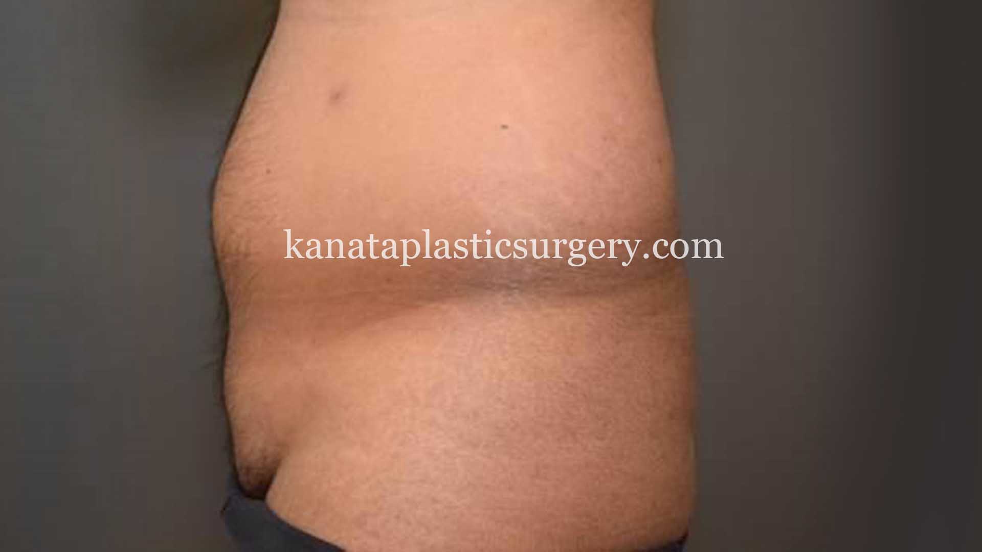 liposuction before after man 1