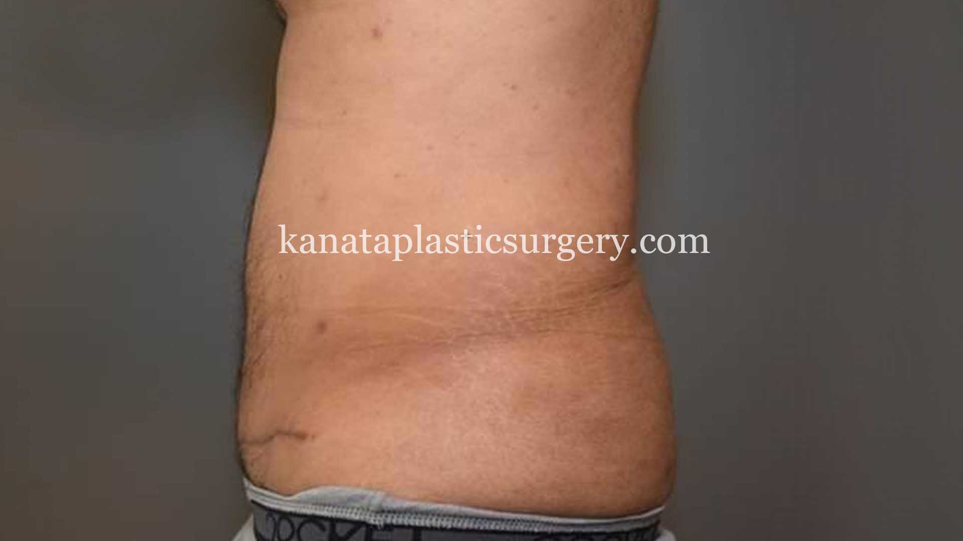 liposuction before after man 2