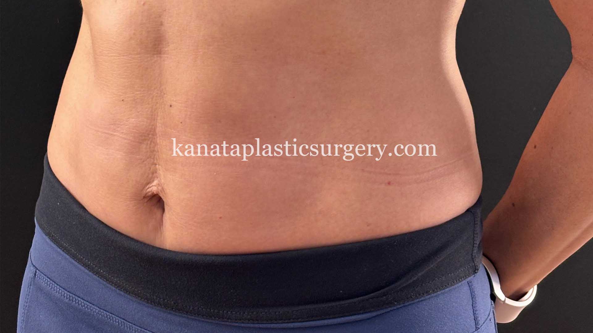 liposuction before after woman 1