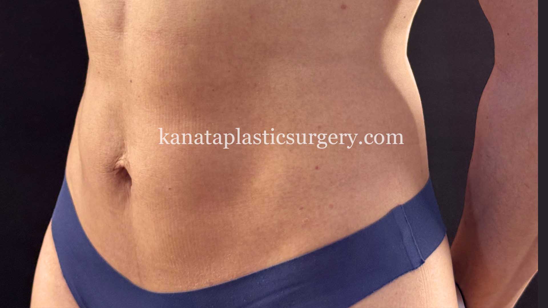 liposuction before after woman 2