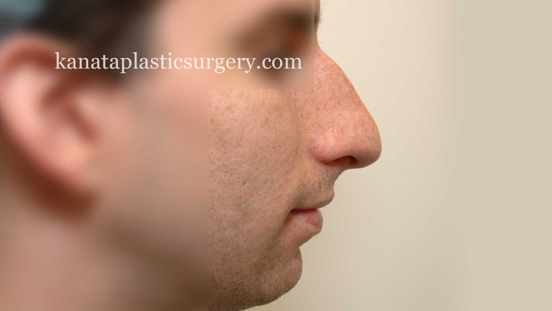 nose job rhinoplasty ottawa 1