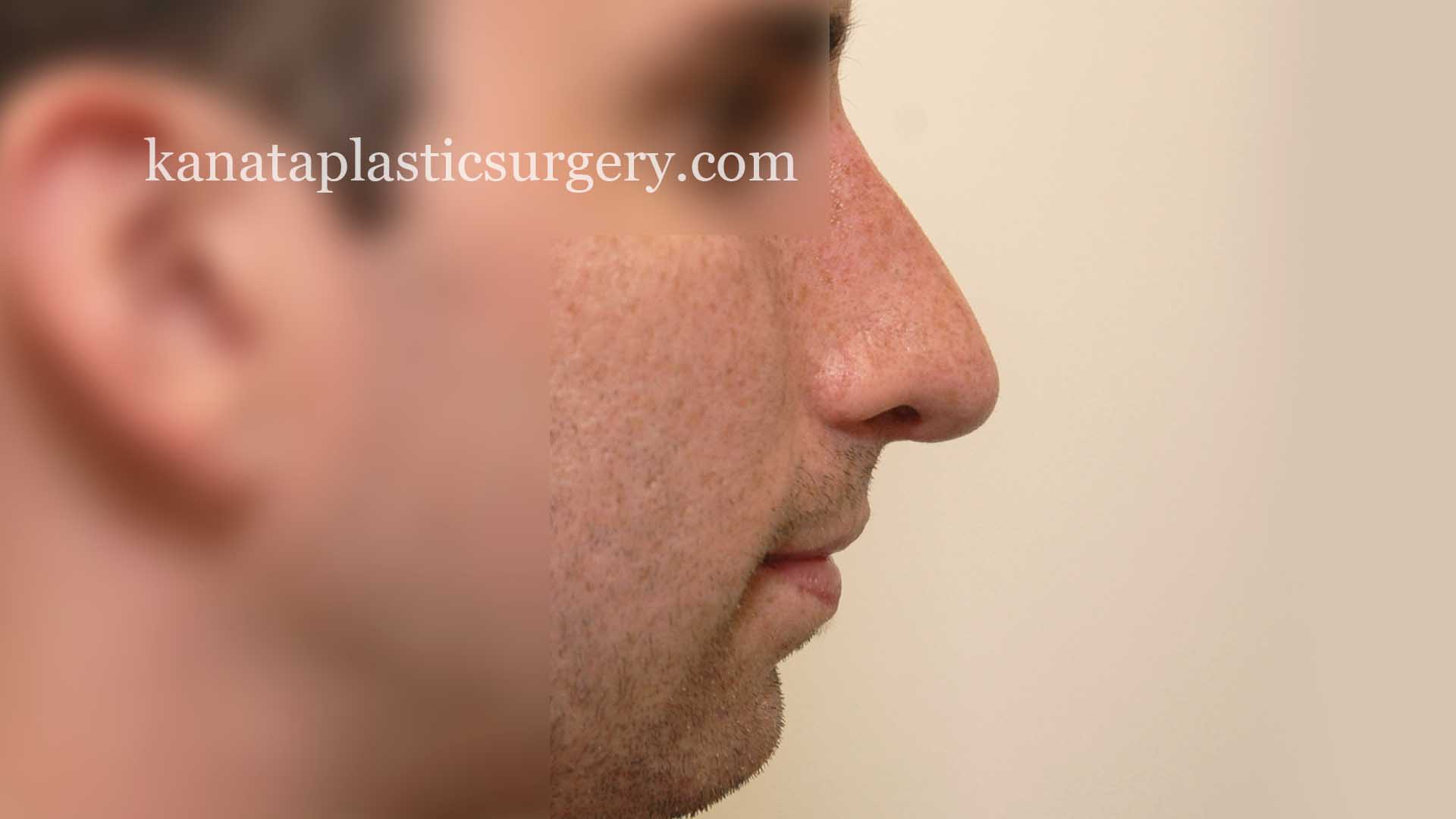 nose job rhinoplasty ottawa 2