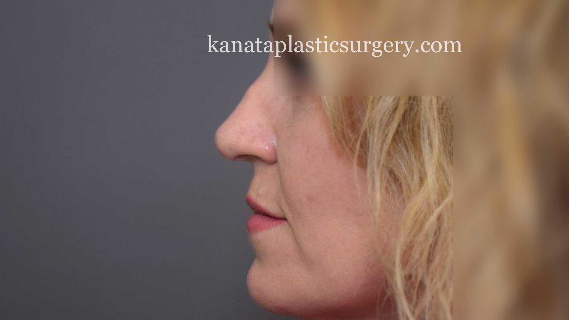 nose job rhinoplasty ottawa plastic surgery 1