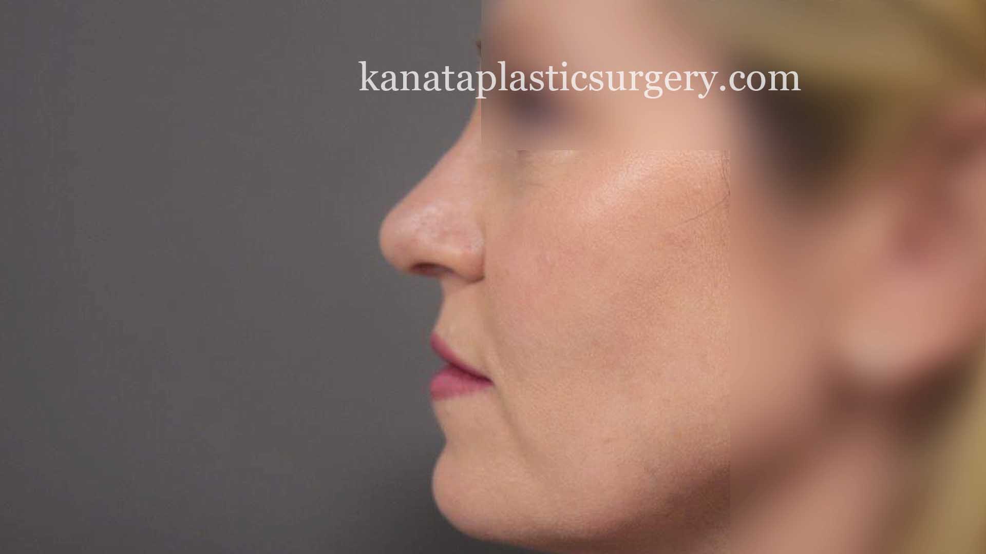 nose job rhinoplasty ottawa plastic surgery 2