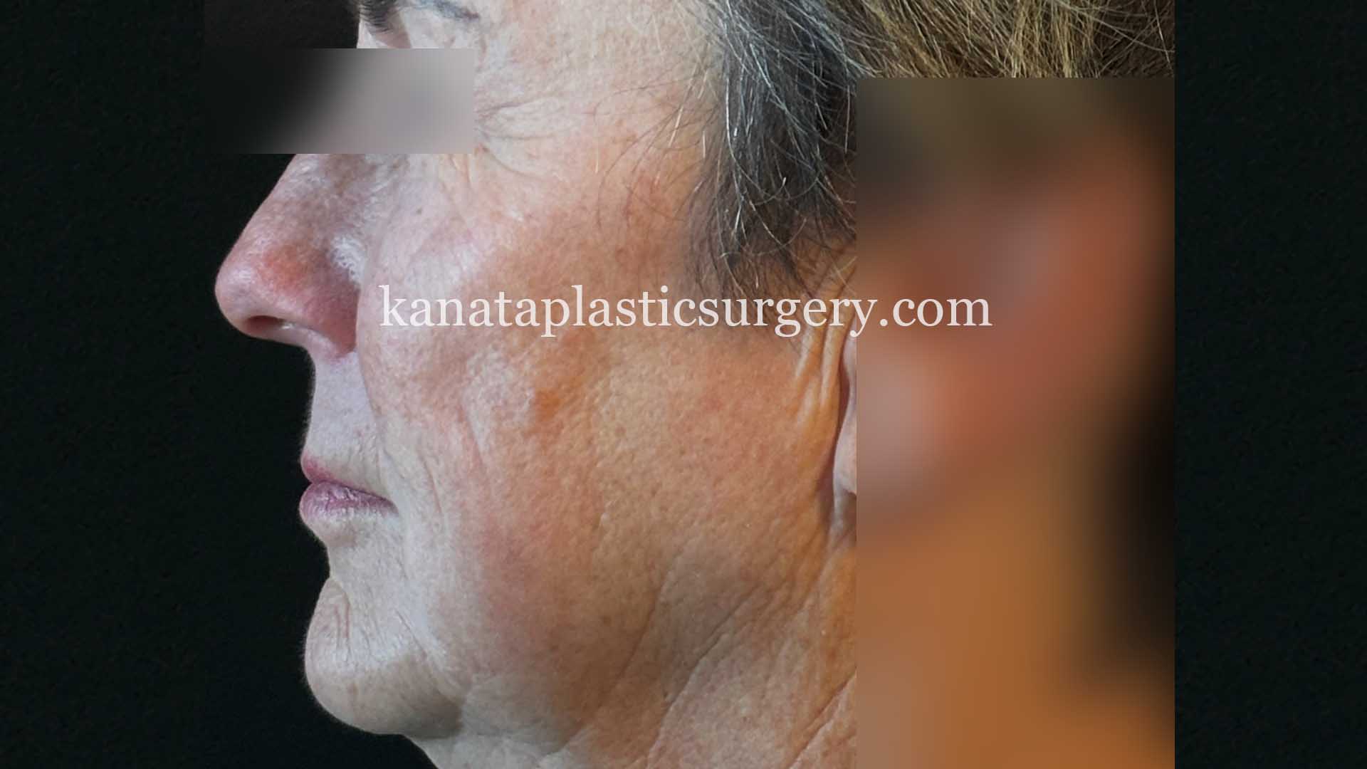 ottawa facelift before after woman 1