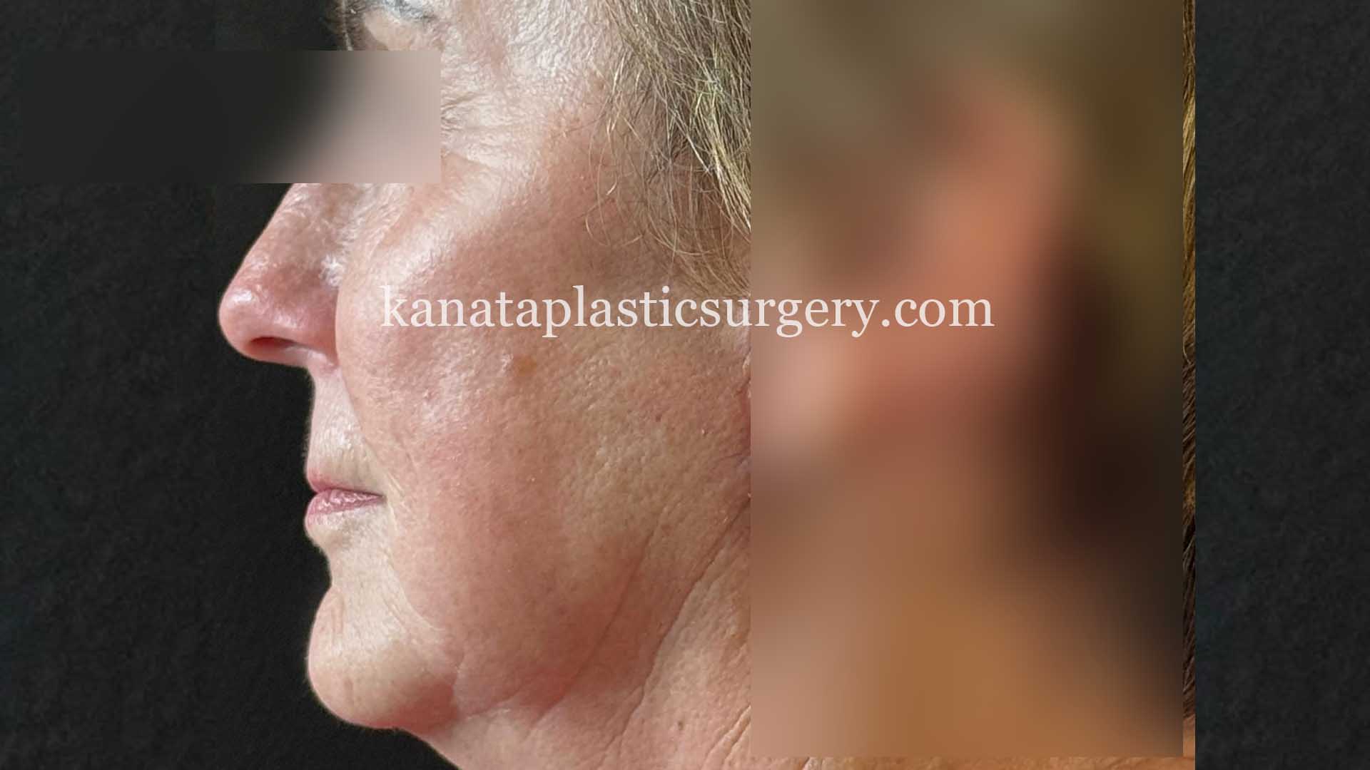 ottawa facelift before after woman 2