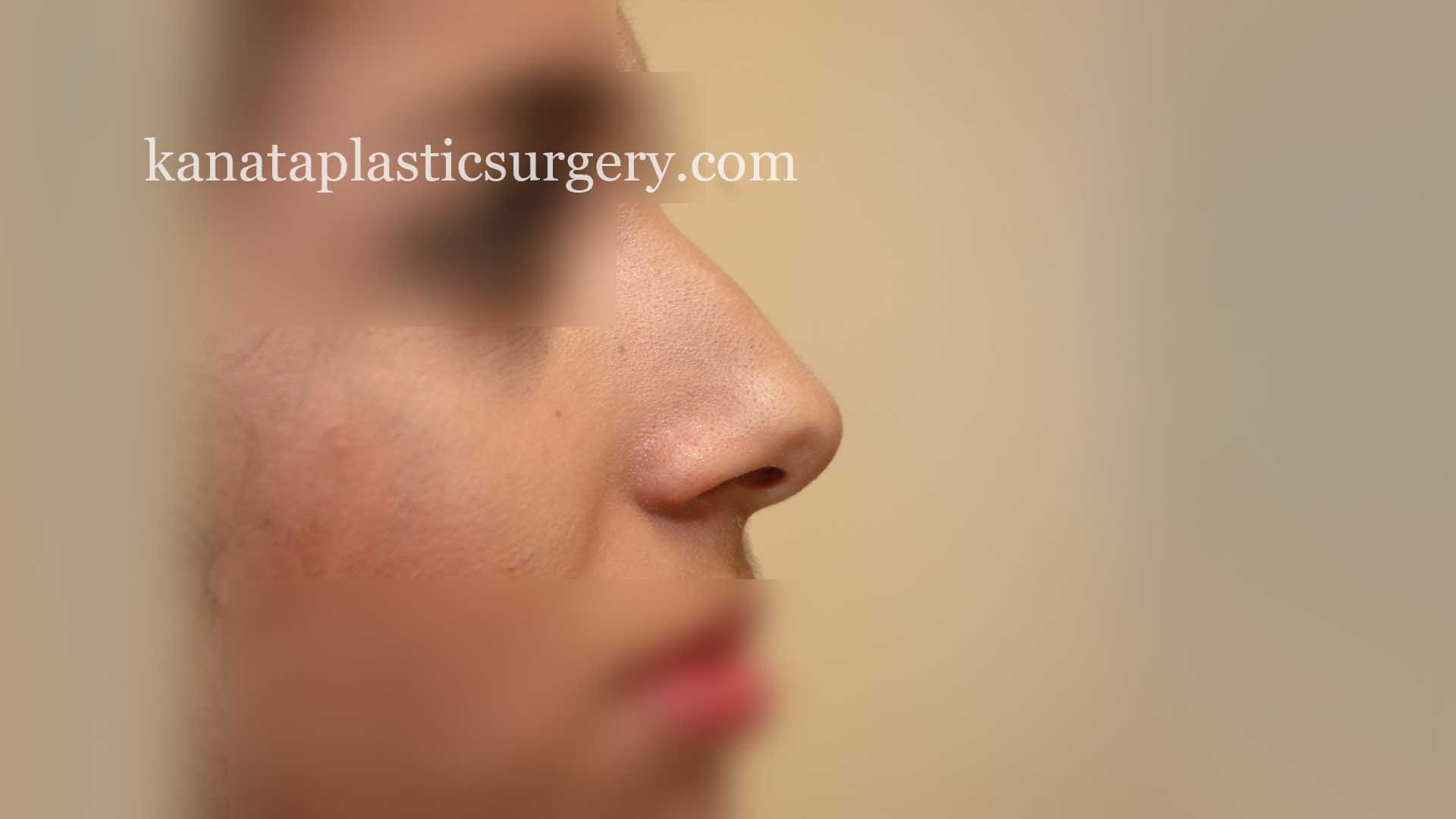 rhinoplasty nose job ottawa 1