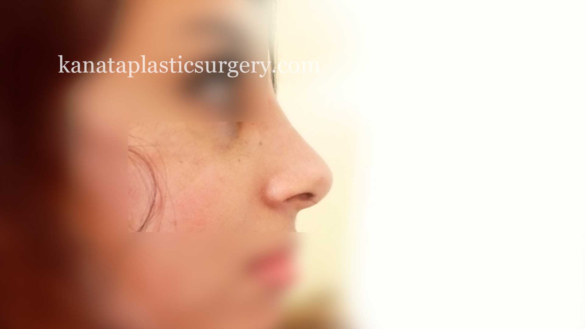 rhinoplasty nose job ottawa 2