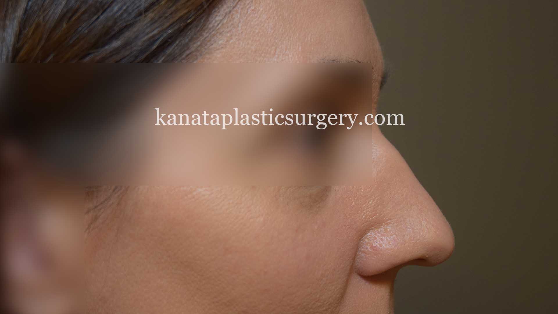 rhinoplasty nose job surgeon 1